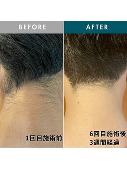 モモナ(Momona)/佐世保/脱毛/うなじ脱毛