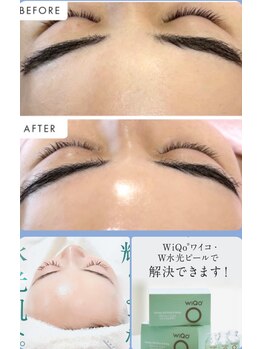 ジュエルビューティー(Jewel Beauty)/ツヤ肌実感WiQo水光ピーリング！
