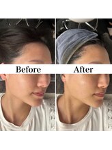 リフェイス(Re:face)/Wピール＋純国産ハーブ