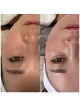 サイウン 辻堂駅前(saiun)/マリムーブフェイシャルワックス