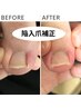 陥入爪補正|原因分析＋再発予防ケア