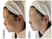 サロンドール(Salon doll)/最新韓国式小顔リフト