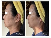 フェイスラインと顎下のたるみ引き締め/シワ改善(施術1回60代)