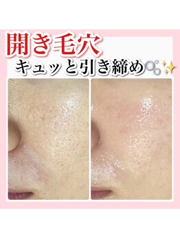 アルムダアクア 天王寺店(Aleumda AQUA)/ハーブピーリング/大阪/天王寺