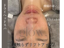 グロウ(glow.)/顔を触らずリフトアップ！