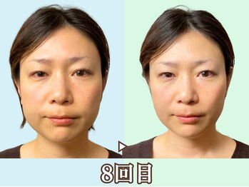 ナチュラルビューティーフェイス 横浜(NBF)/エラ、頬骨、フェイスライン整う