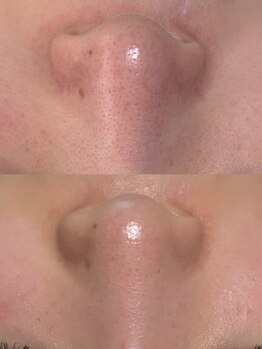 サロンドミュウ(Salon de Mieux)の写真/【ぴかぴか毛穴を目指したい方】本気の肌質改善で開いた毛穴にアプローチ、毛穴レスのお肌を目指せます♪
