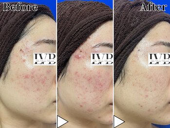 ラヴレボーテ(La Vraie Beaute)/20代・にきび・改善期間3ヶ月