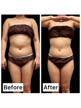 クールヴィラ(Cool Villa)/下腹ビフォーアフター