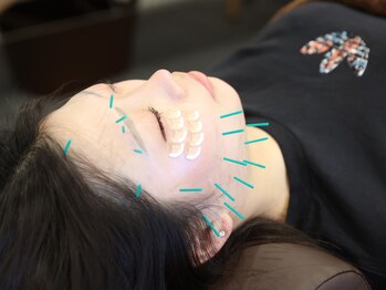 ピース鍼灸整骨院 古川橋院/プレミアム美容鍼(80本)