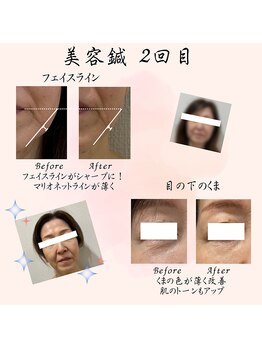 こころ整骨院 こころ鍼灸院/美容鍼2回での変化