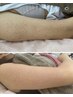サメ肌改善！腕の赤いポツポツ・ザラザラにハーブピーリング