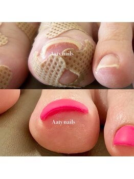 アーティネイルズ(Aaty Nails)/巻き爪が引上がる不思議なネイル