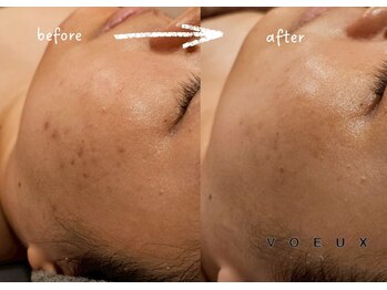 ボウ 静岡本店(VOEUX)/大人ニキビ 3回