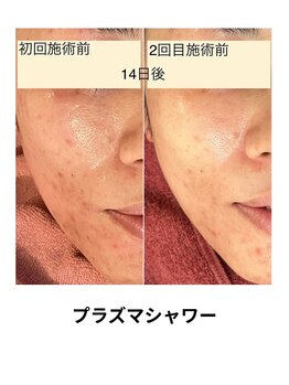 ビービー(BB)/毛穴洗浄＋プラズマ照射
