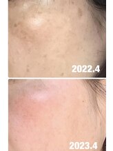 エスポワール(espoir)/ハーブピーリング症例