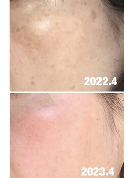 エスポワール(espoir)/ハーブピーリング症例