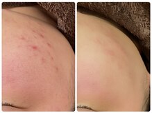 ハーブピーリング 恵比寿/ハーブピーリングbefore→after