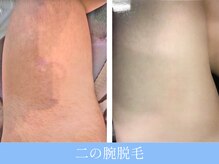 オーシャンブルー 大分店(OCEAN BLUE)/二の腕脱毛