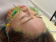 ソラナ(Solana)/大人気の百華鍼