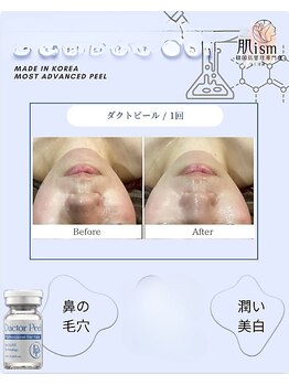 肌イズム 守谷店(肌ism)/【before&after】ダクトピール