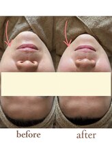 スリラ(SuriLa)/◆ビフォーアフター◆