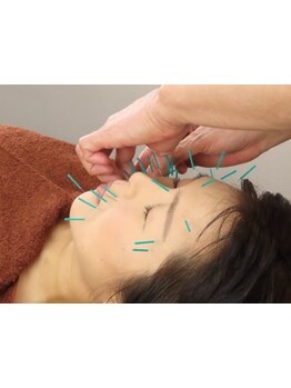 鍼灸施術を受けたい