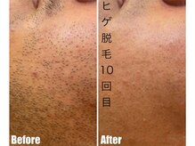 CDF 赤坂/メンズヒゲ脱毛10回目初回￥1000