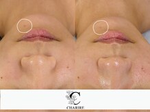 シャリル(charire)/一回で赤みも抑えられます