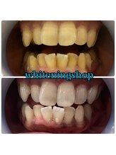 ホワイトニングショップ 大阪玉造店/Before&After美白ホワイトニング