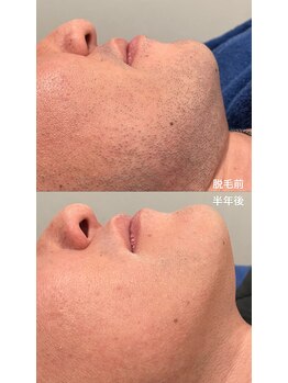 プラチナムニイガタ 新潟(PLATINUM NIIGATA)/ヒゲ脱毛