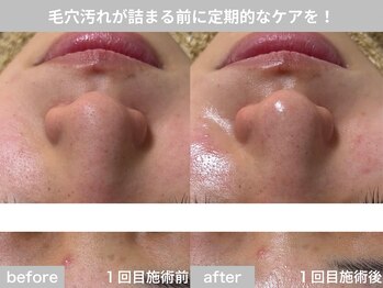 サロン ビュー(salon view)/30代女性〈毛穴黒ずみ悩み〉