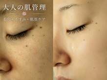 マールム(MALUM)の雰囲気（肌悩みに合わせて選べる本格肌管理。土台から整えるピーリング！）