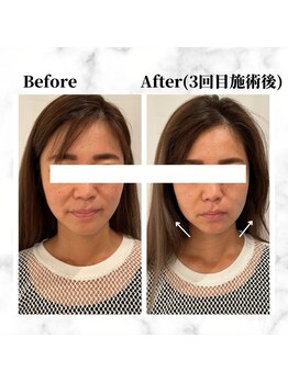 ザビューティー 麻布十番本店(The Beauty)/12Dリフト全顔打ち放題[リフト]