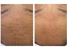 ナルフロウ(nalufurou)/独自配合の国産ハーブピーリング