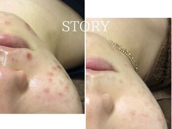 ストーリー 沼津店(STORY)/ハーブピーリング専門店STORY