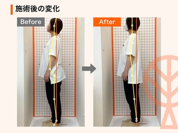 ただき接骨院 整体院 高崎本院/施術後の変化：反り腰