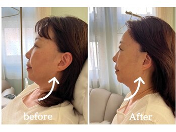 ミラ 中央林間(mira)/小顔　毛穴　ホワイトニング