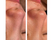 チェンジ(Change)/ハイドラフェイシャル