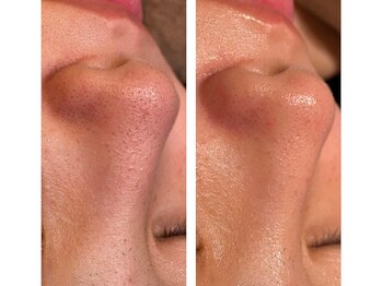 チェンジ(Change)/ハイドラフェイシャル