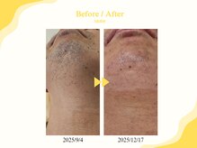 アールスサロンの雰囲気（メンズ髭・光脱毛のビフォーアフター）