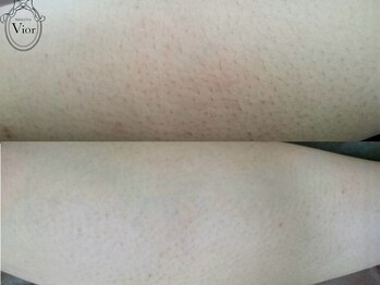 ヴィオール 名古屋栄店(VIOR)/【レデイース脱毛】 ふくらはぎ