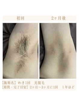 エース 赤坂/わき脱毛経過写真