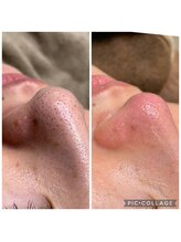 スイ(SUI)/毛穴の黒ずみ/開き/イチゴ鼻