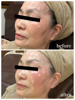 ジャスミン(Jasmin)/エステティック×シェービング