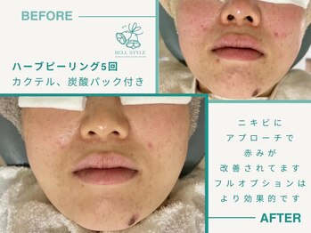 ベルスタイル(Bell style)/当店のお客様症例(ハーブ)