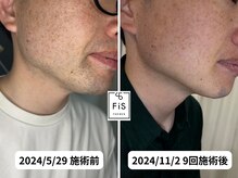 フィズ 多摩センター店(FIS)/☆脱毛途中経過［多摩センター］