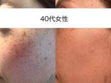 サクラ 本厚木駅前店(SAKURA)/本厚木シミケア/伊勢店シミケア