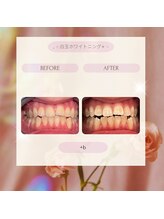 プラスビー 2号店(+b)/ホワイトニングビフォーアフター
