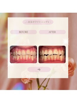 プラスビー 2号店(+b)/ホワイトニングビフォーアフター